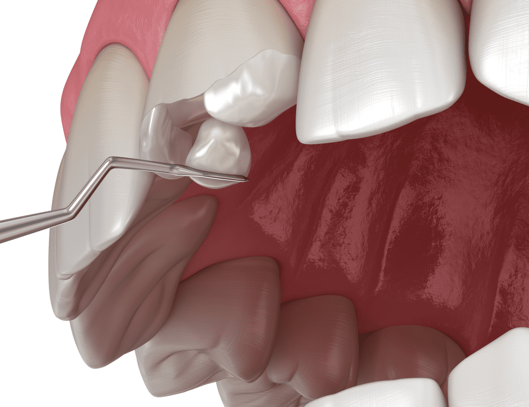 наращивания зуба переднего фото